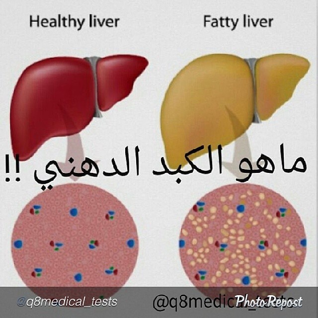 الكبد الدهني
